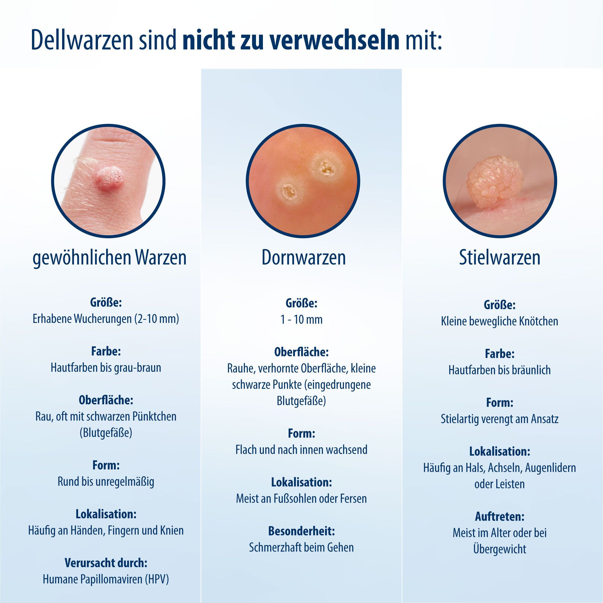Grafik mit Informationen über Dellwarzen. Vergleich mit Warzen. Größen, Farben, Formen, Lokalisation.