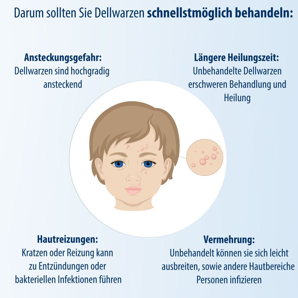 Grafik mit Informationen über Dellwarzen. Kind mit Dellwarzen. Ansteckungsgefahr, Hautreizungen, etc.