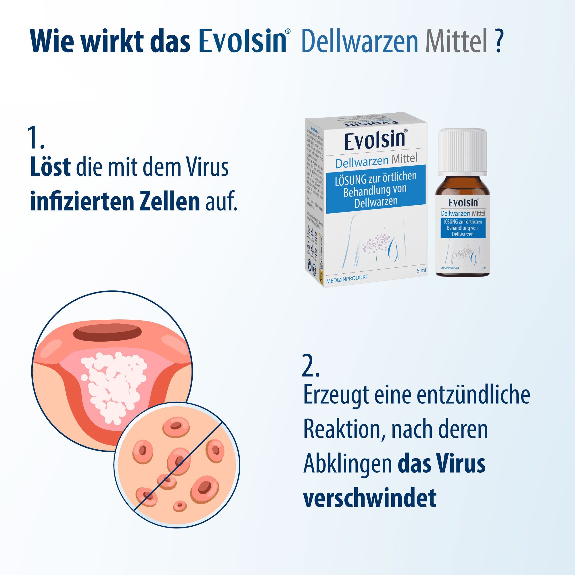 Grafik: Wie wirkt das Evolsin Dellwarzen Mittel? 1. Zellen auflösen. 2. Entzündungsreaktion.