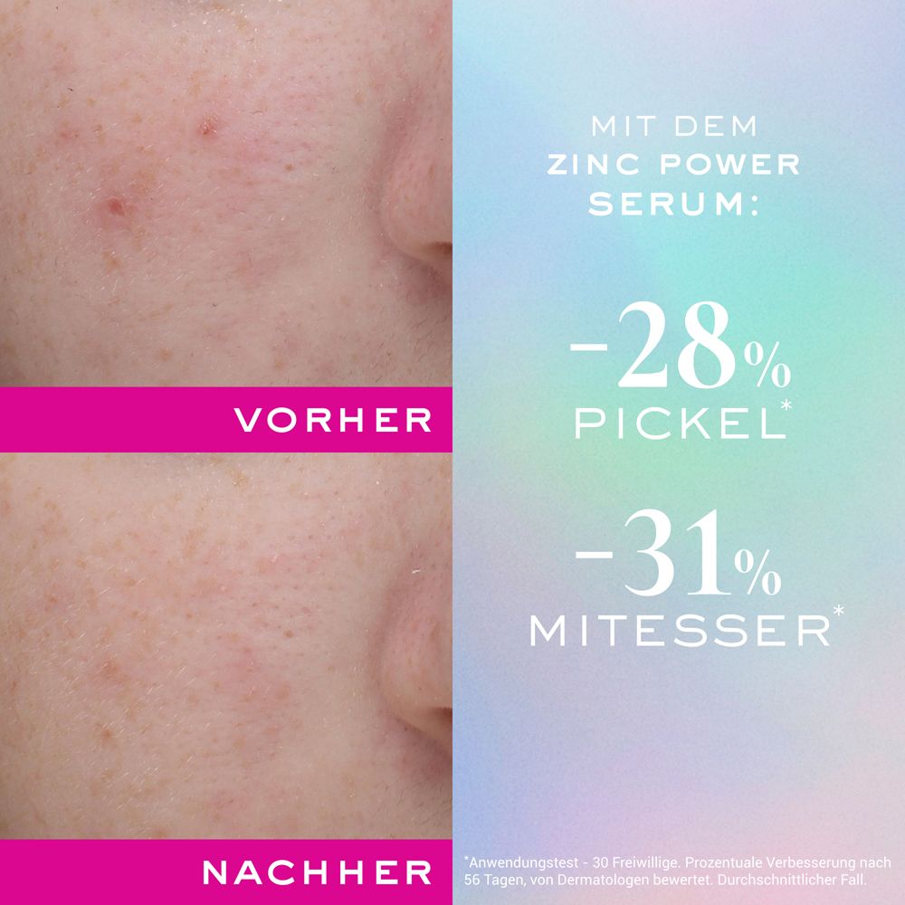 Vorher-Nachher-Vergleich. Text: -28% Pickel, -31% Mitesser. Haut mit Pickeln, dann verbesserte Haut.