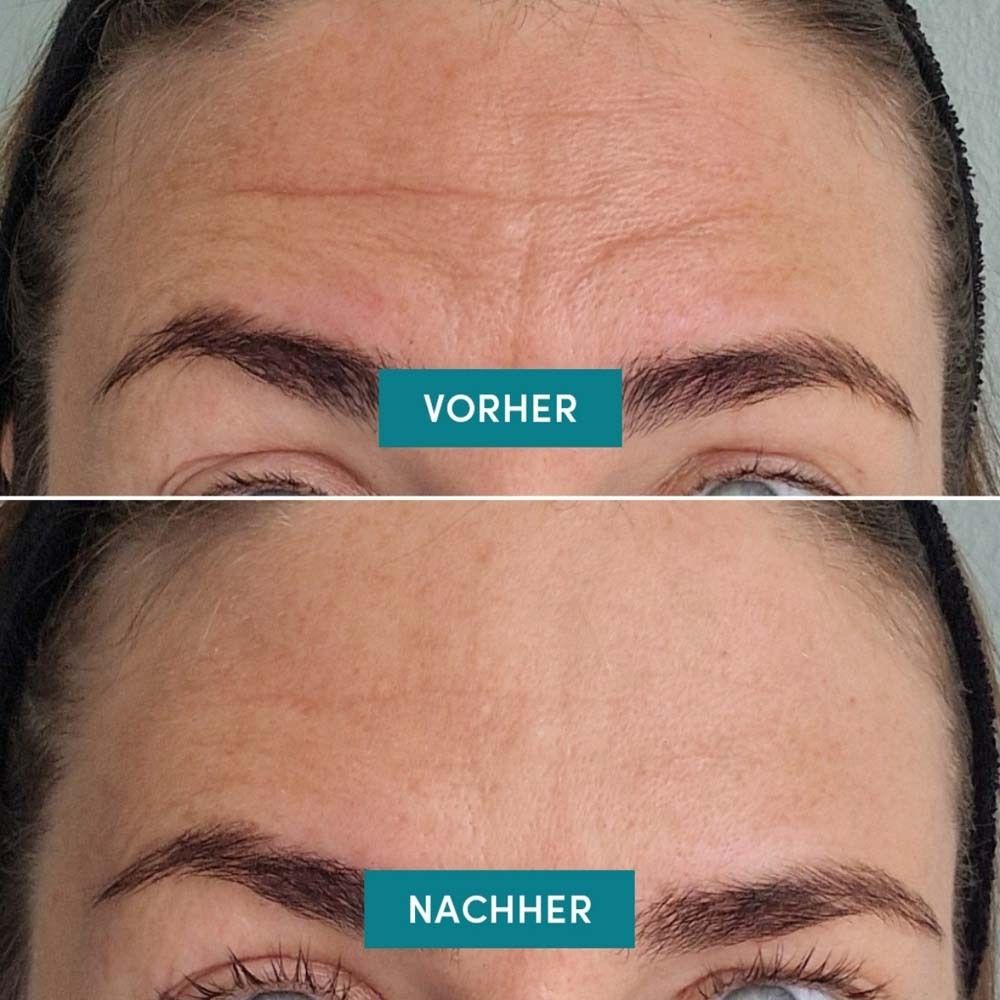 Vorher-Nachher-Vergleich. Obere Reihe: Stirn mit Falten. Untere Reihe: Glatte Stirn. Text: Vorher, Nachher.