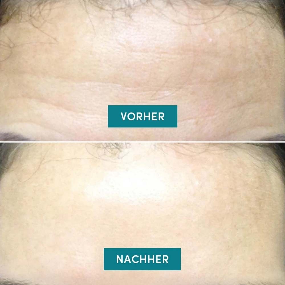 Vorher-Nachher-Vergleich. Zwei Fotos von Stirnen. Oben: Falten. Unten: Glatte Haut. Text: Vorher, Nachher.