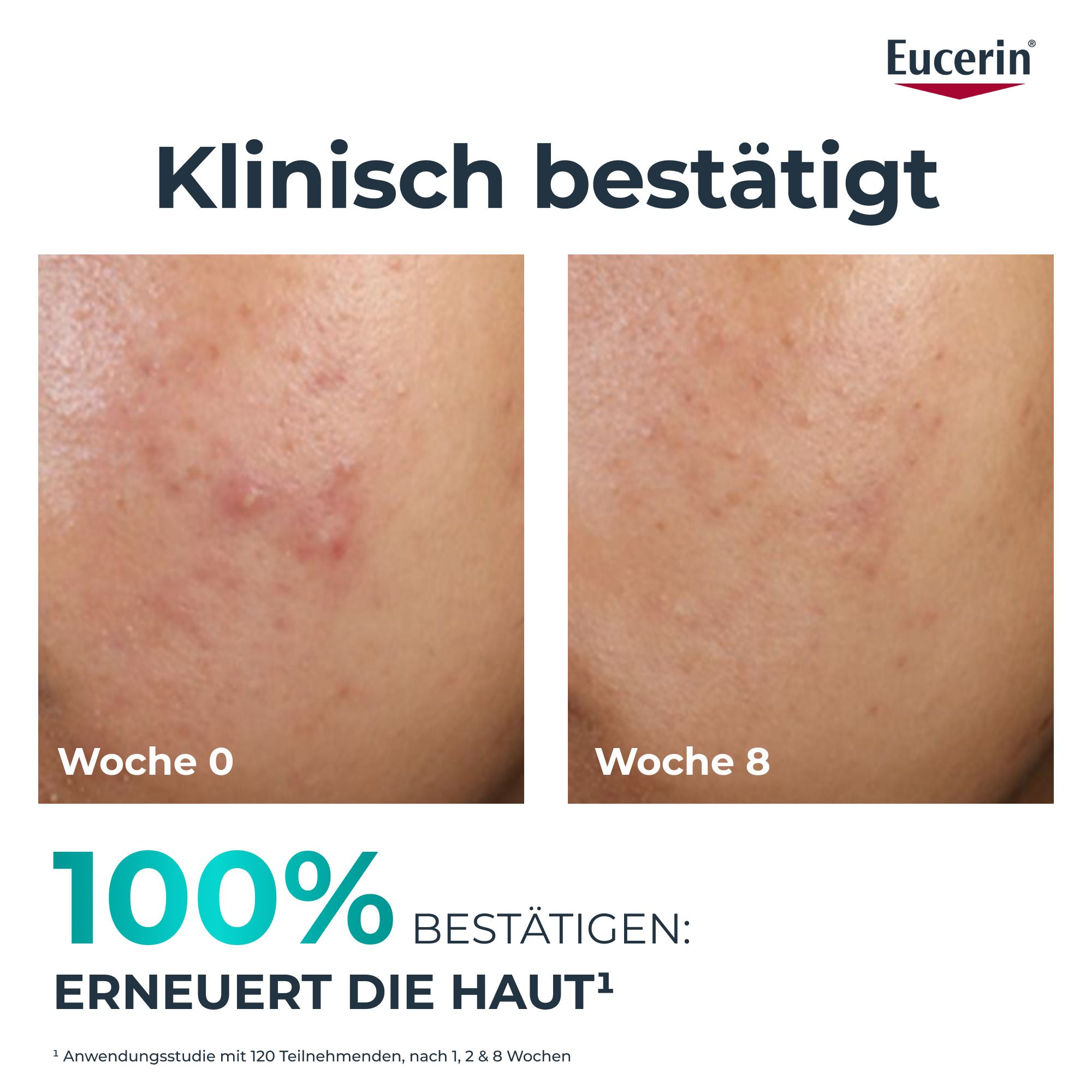 Gesicht mit Hautunreinheiten. Text: Klinisch bestätigt. Woche 0 und Woche 8. Text: Erneuert die Haut.