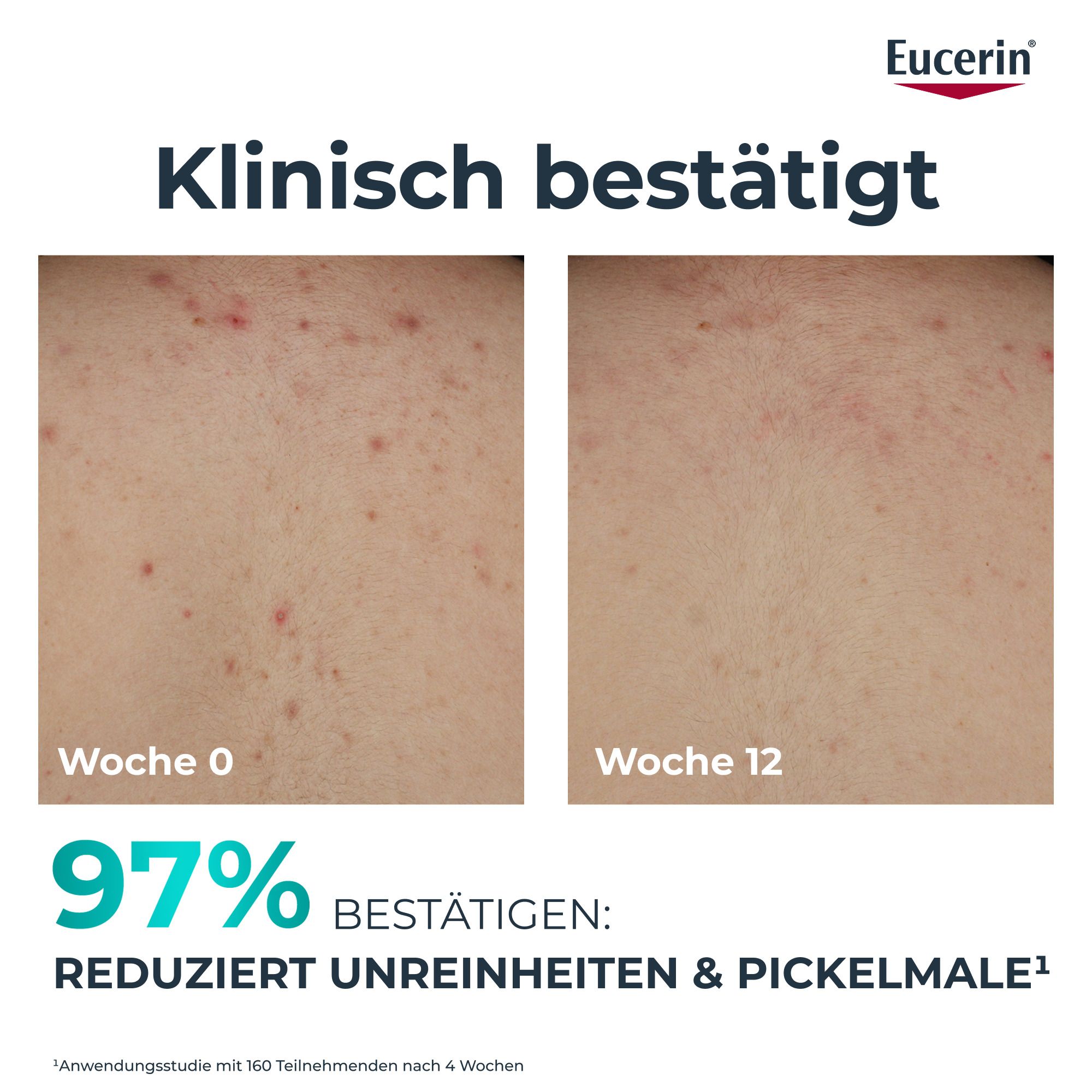 Vorher-Nachher-Bilder. Text: Klinisch bestätigt. 97% bestätigen: reduziert Unreinheiten & Pickelmale. Eucerin-Logo.