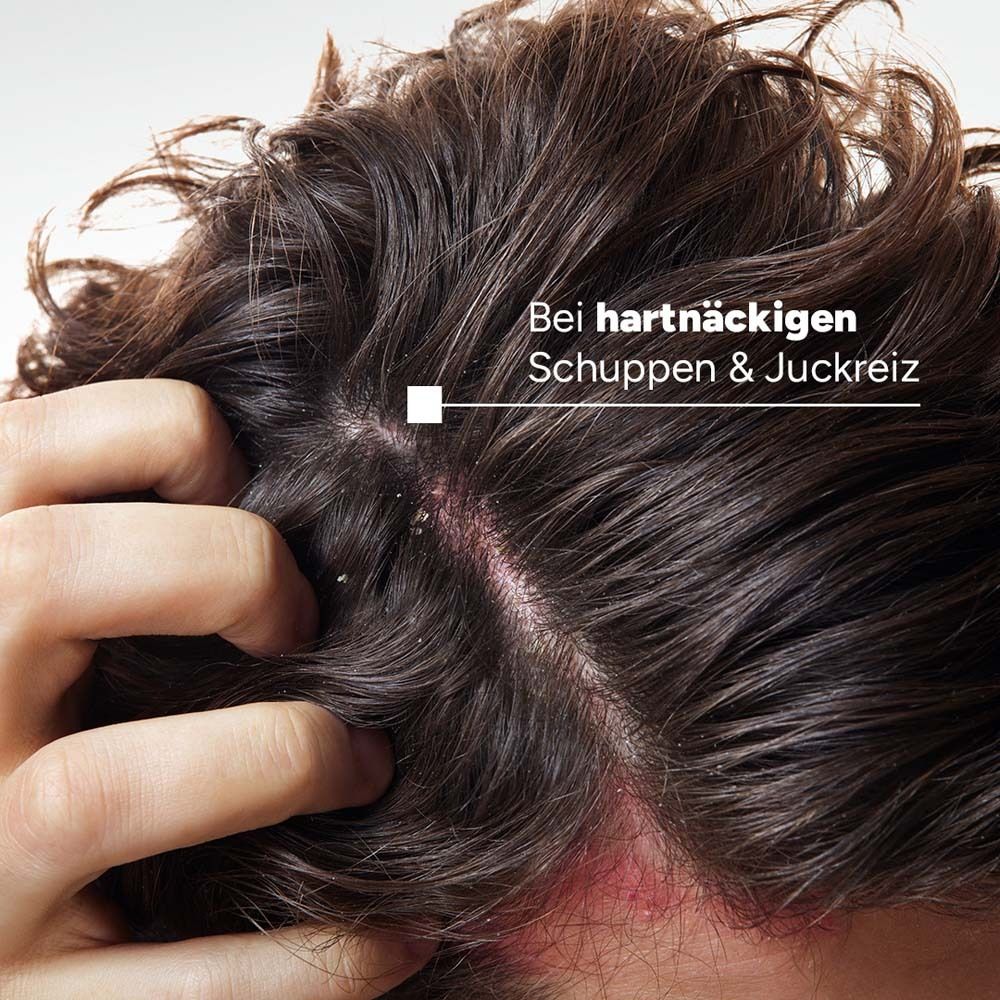 Nahaufnahme einer Kopfhaut mit Schuppen und Rötungen. Text: Bei hartnäckigen Schuppen & Juckreiz.