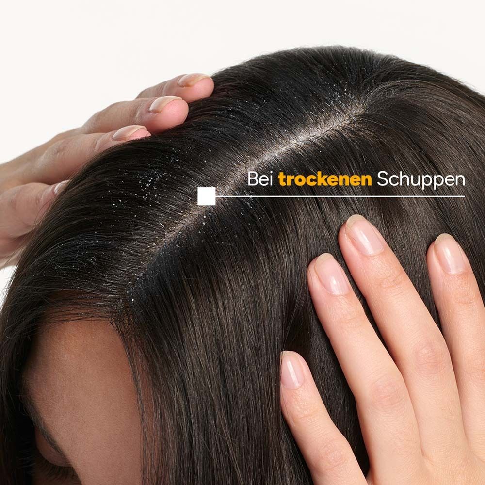 Nahaufnahme von Kopfhaut mit trockenen Schuppen. Hände berühren die Kopfhaut. Text: Bei trockenen Schuppen.