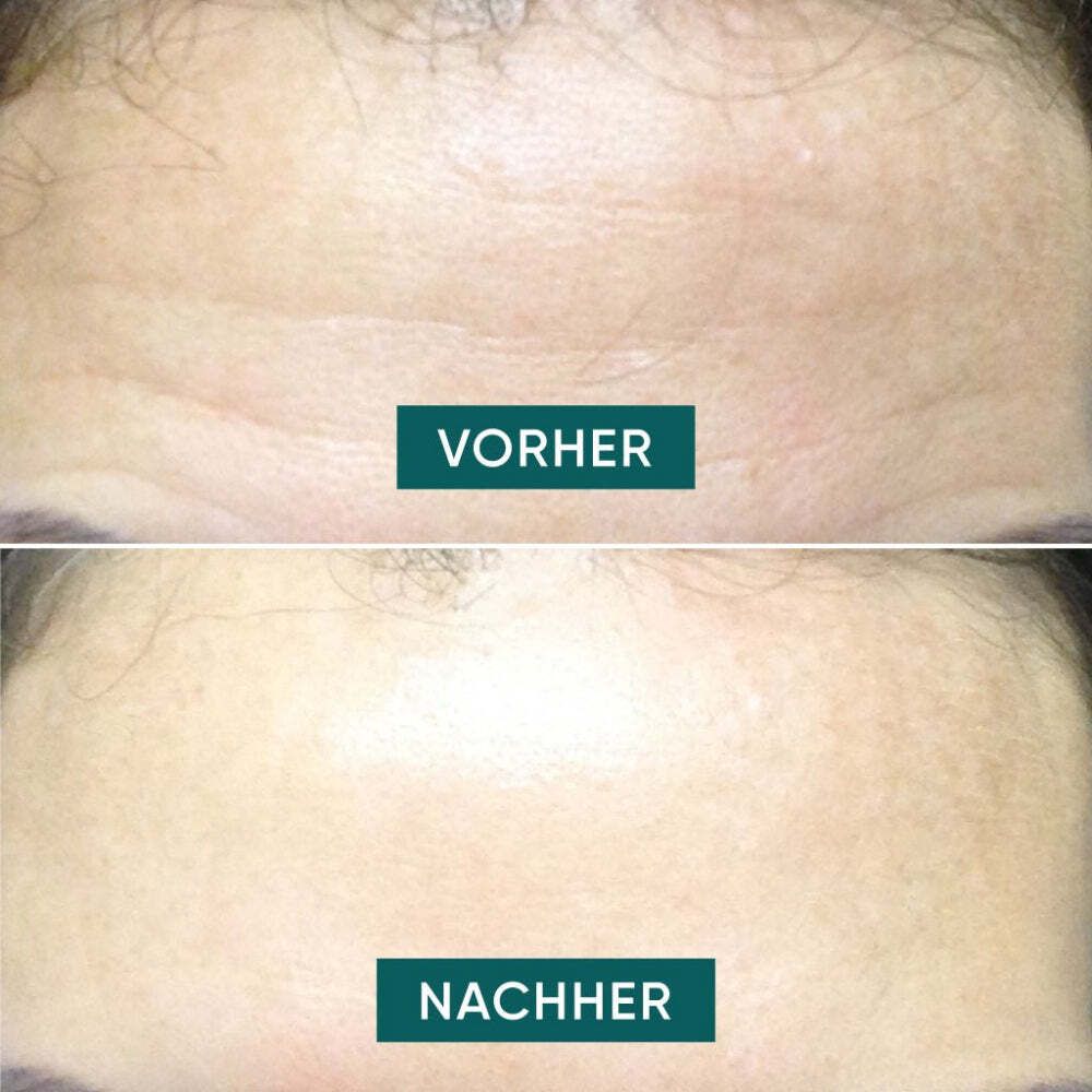 APRICOT Stirn Pad mit Aloe Vera - Wiederverwendbar