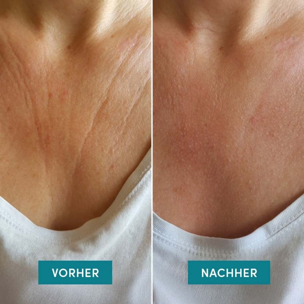 Vorher-Nachher-Vergleich. Dekolleté mit Falten (Vorher) und glatter Haut (Nachher).