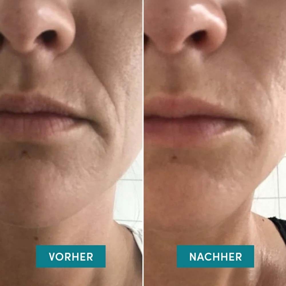 Vorher-Nachher-Vergleich: Lippen mit Falten, dann glattere Lippen.