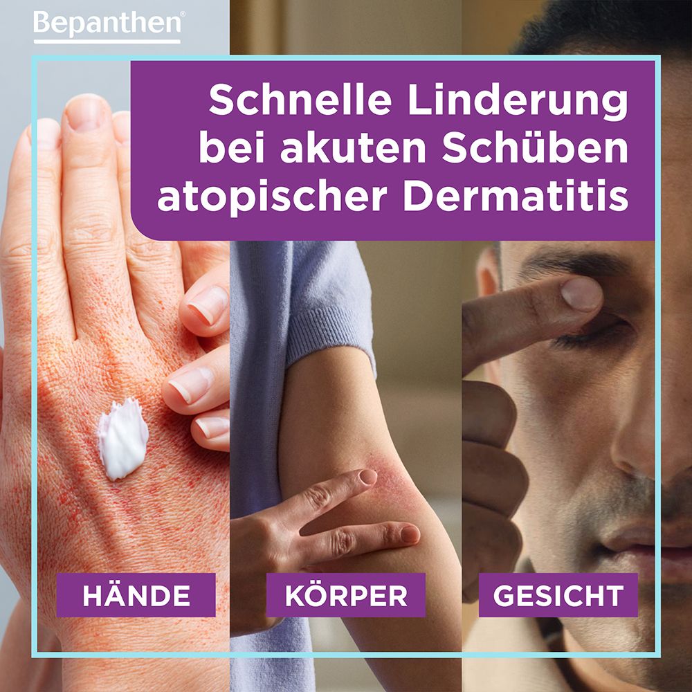 Hände, Körper, Gesicht: Schnelle Linderung bei akuten Schüben atopischer Dermatitis.