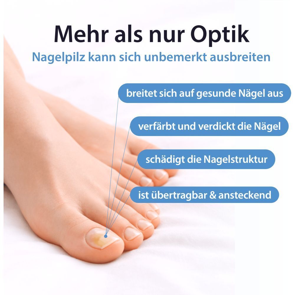 Füße mit gesunden und infizierten Nägeln, die die Ausbreitung von Nagelpilz illustrieren.