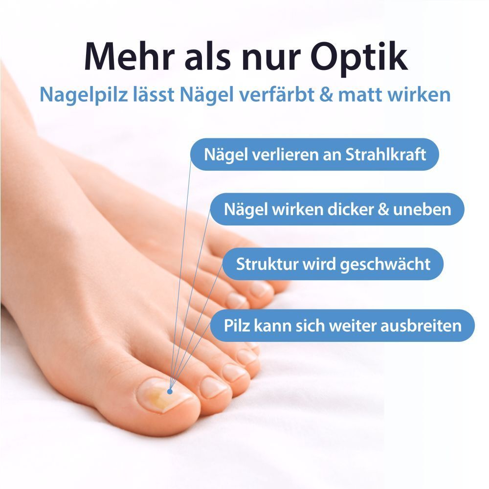Nahaufnahme eines Fußnagels mit Nagelpilz. Erläutert Symptome wie Verfärbung und Strukturverlust.