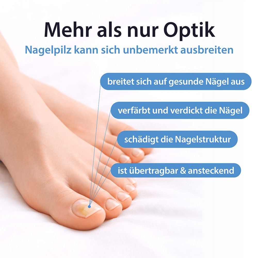 Nahaufnahme eines Fußnagels mit Pilzinfektion, daneben Erklärungen zur Ausbreitung.