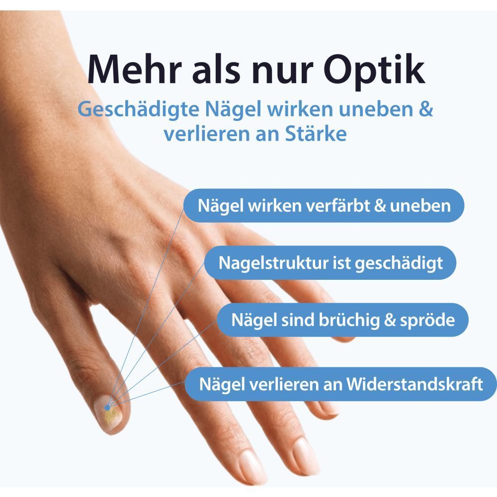 Hand mit beschädigtem Nagel, der die Probleme verfärbte, unebene, brüchige Nägel zeigt.