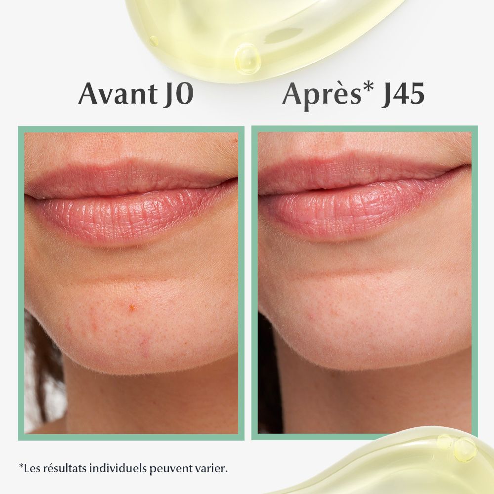 Vorher-Nachher-Bilder von Lippen. Ergebnisse nach 45 Tagen. Text: Ergebnisse können variieren.