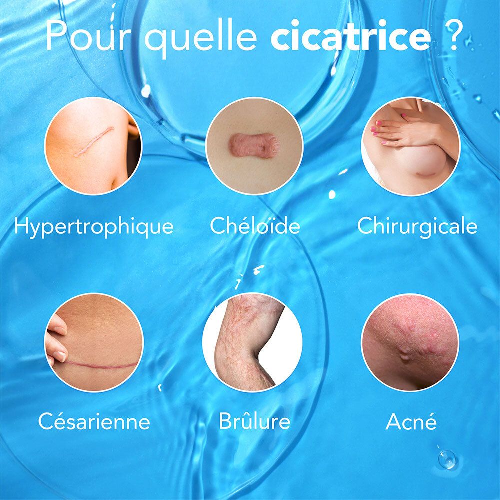 Images de types de cicatrices : hypertrophique, chéloïde, chirurgicale, césarienne, brûlure, acné.