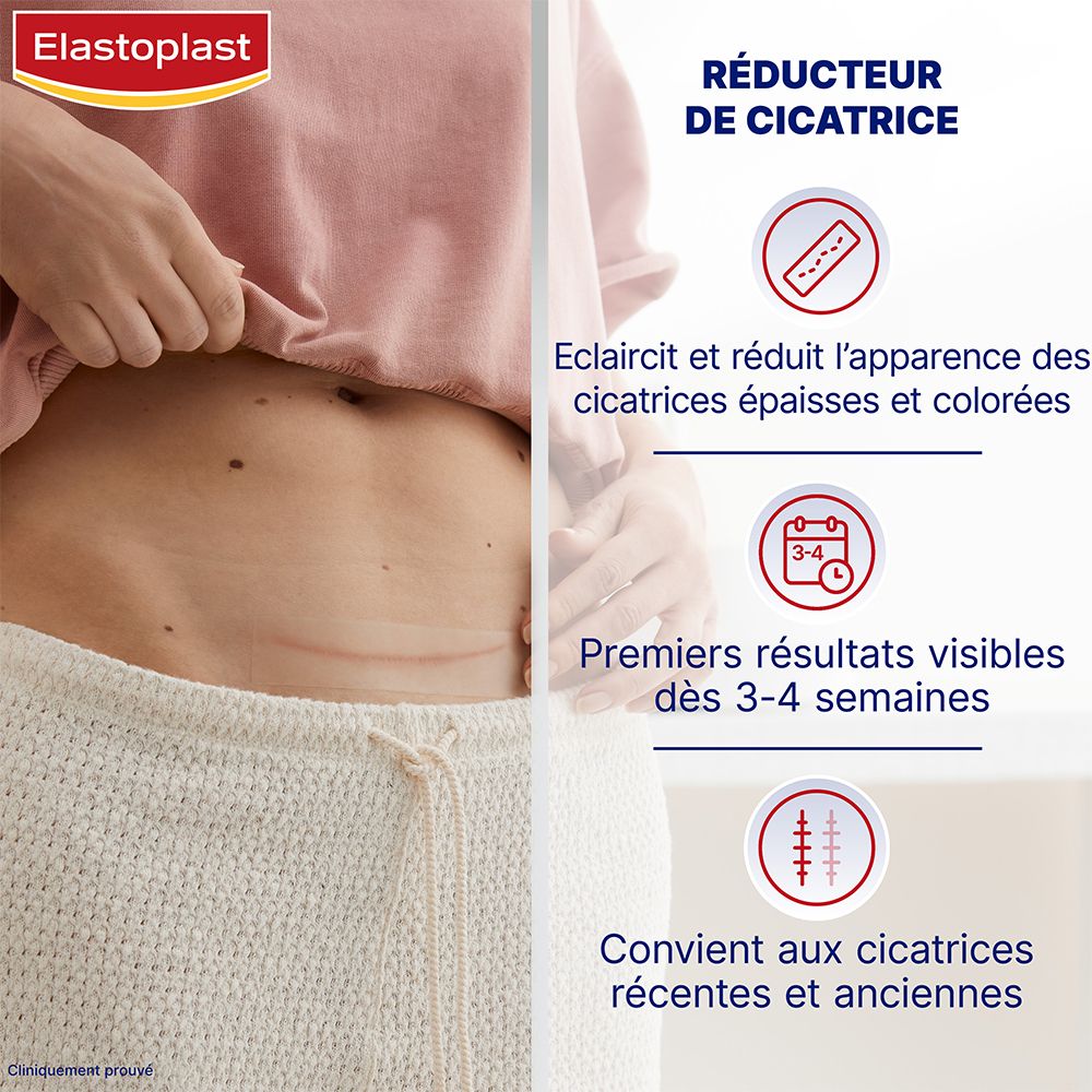 Ventre avec cicatrices. Graphiques : réduction, résultats en 3-4 semaines, convient aux cicatrices récentes et anciennes.