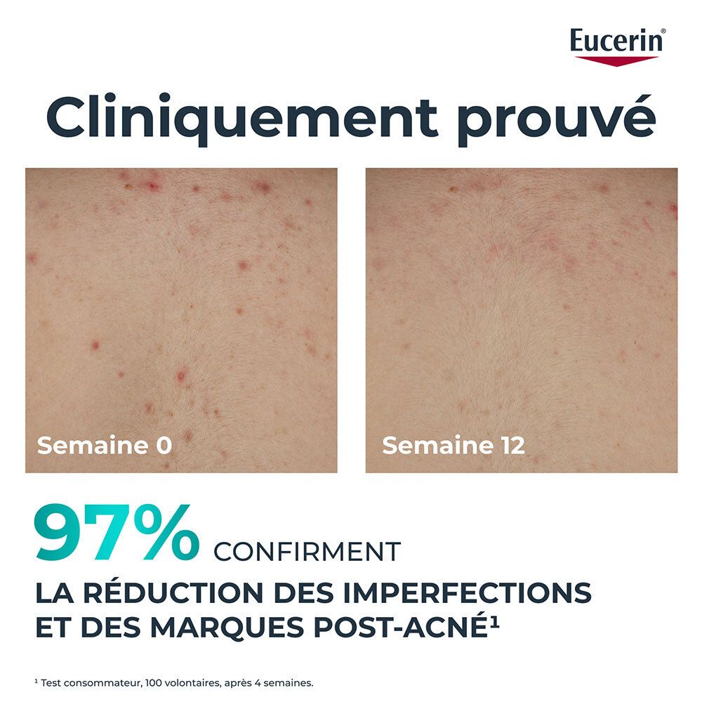Comparaison de la peau. Gauche: Semaine 0. Droite: Semaine 12. Texte: 97% confirment la réduction des imperfections.