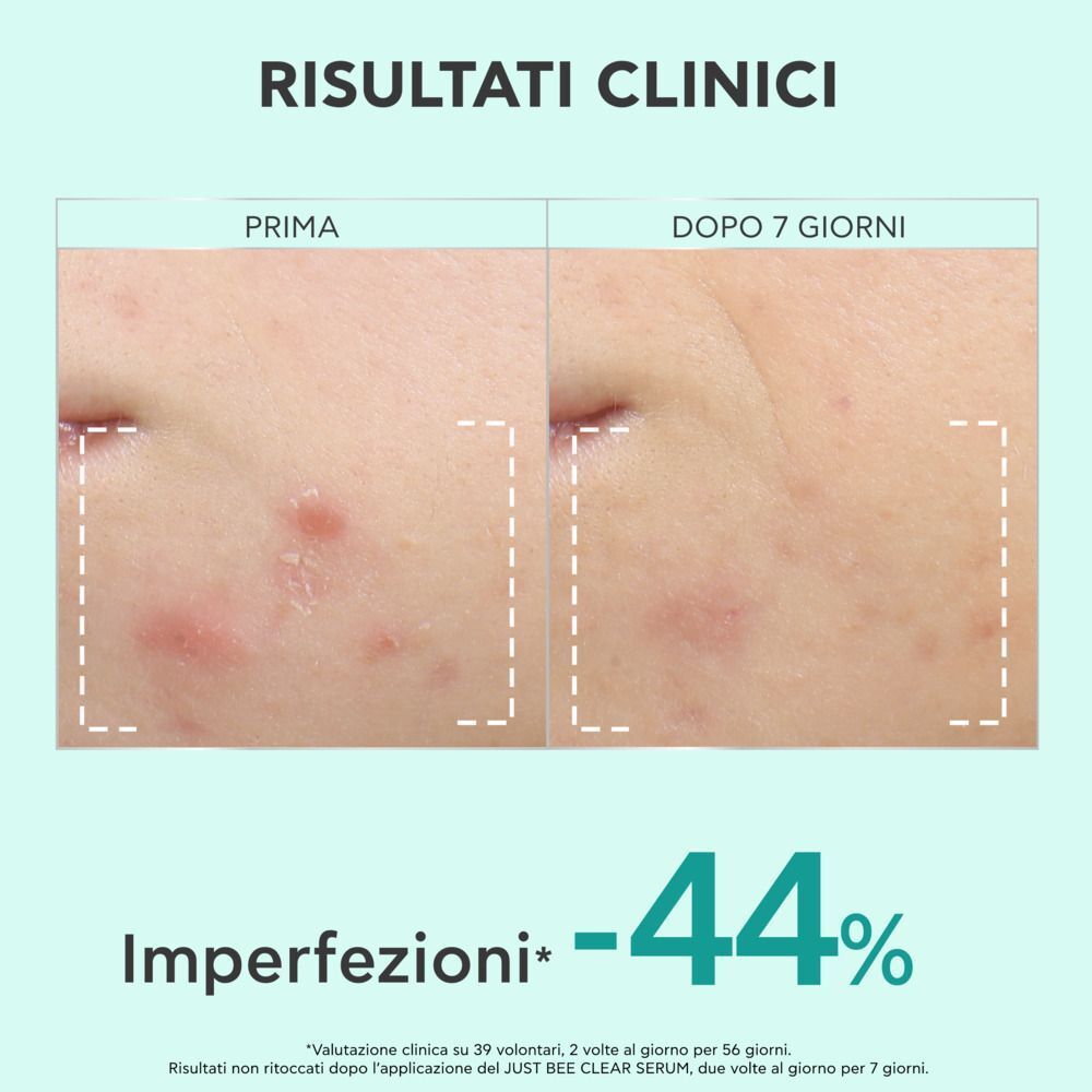 Confronto prima e dopo delle imperfezioni della pelle dopo 7 giorni. Testo in italiano.