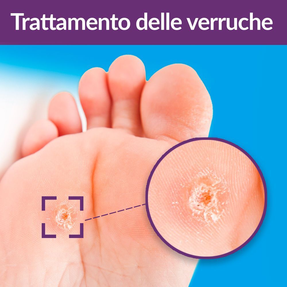 Primo piano di una verruca sul piede, con ingrandimento per illustrare il trattamento.