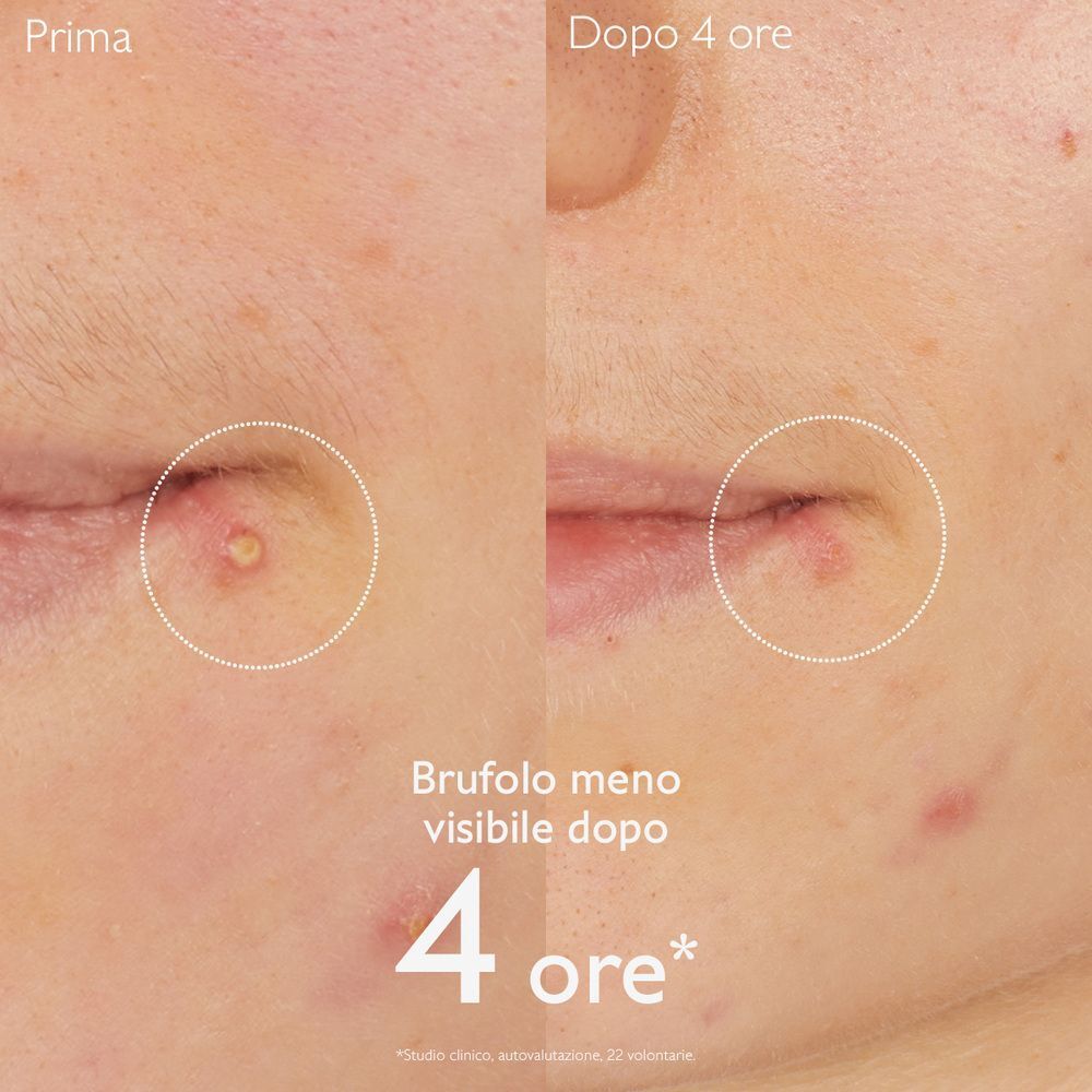 Confronto prima/dopo di un brufolo dopo 4 ore con Caudalie Vinopure.