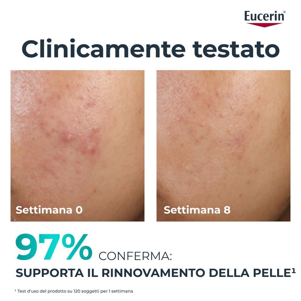 Confronto prima e dopo di pelle acneica trattata con Eucerin Dermopure.