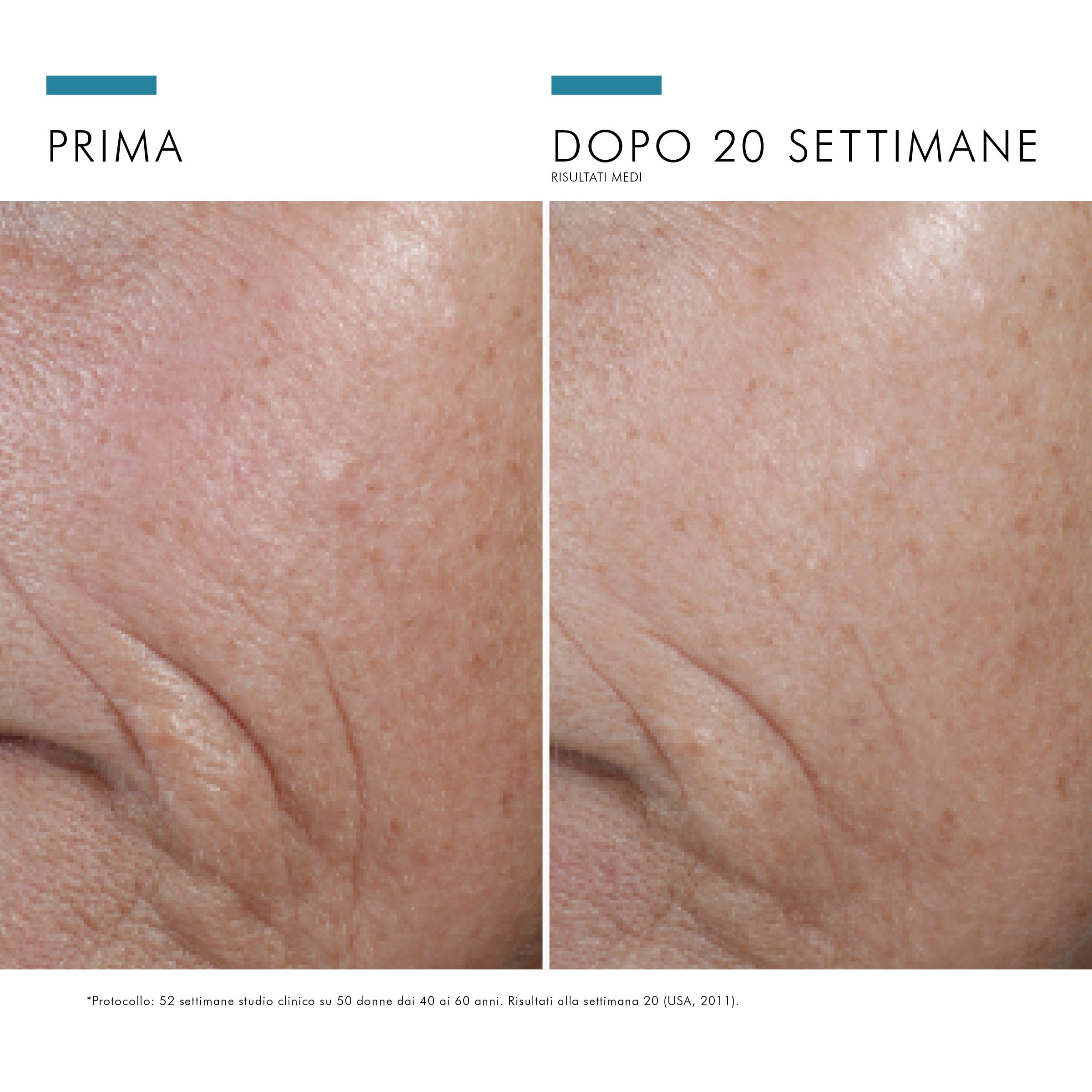 Visage avec rides avant et après 20 semaines. Amélioration de la peau.