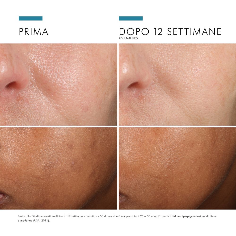 Comparaison avant-après de visages. Images de peau avant et après 12 semaines. Résultats : amélioration de la peau.