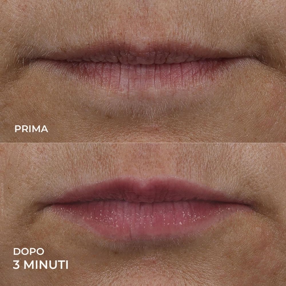 Confronto prima-dopo delle labbra. Dopo 3 minuti. Labbra visibilmente più piene.