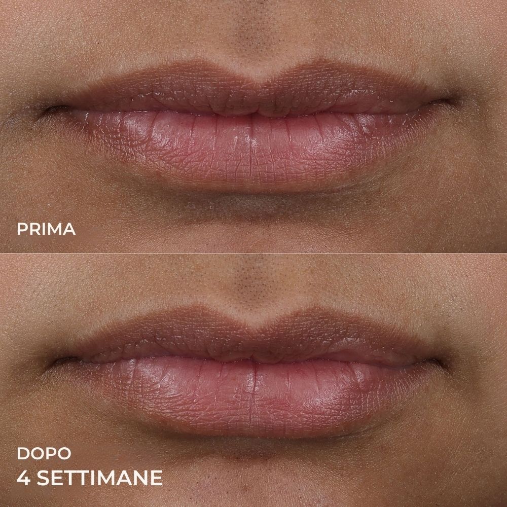 Confronto prima-dopo delle labbra. Dopo 4 settimane. Labbra visibilmente più piene.