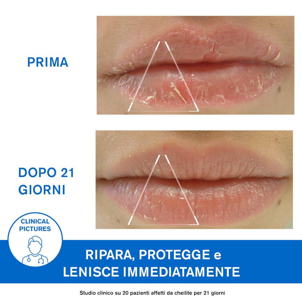 Confronto prima-dopo delle labbra. Ripara, protegge e lenisce immediatamente. Immagini cliniche. Dopo 21 giorni.