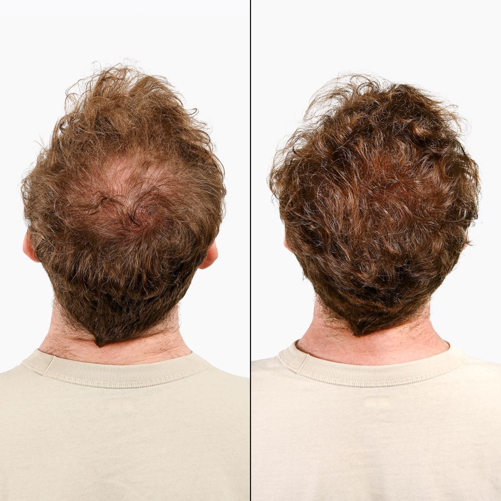 Due viste di un uomo con perdita di capelli. Confronto prima/dopo.