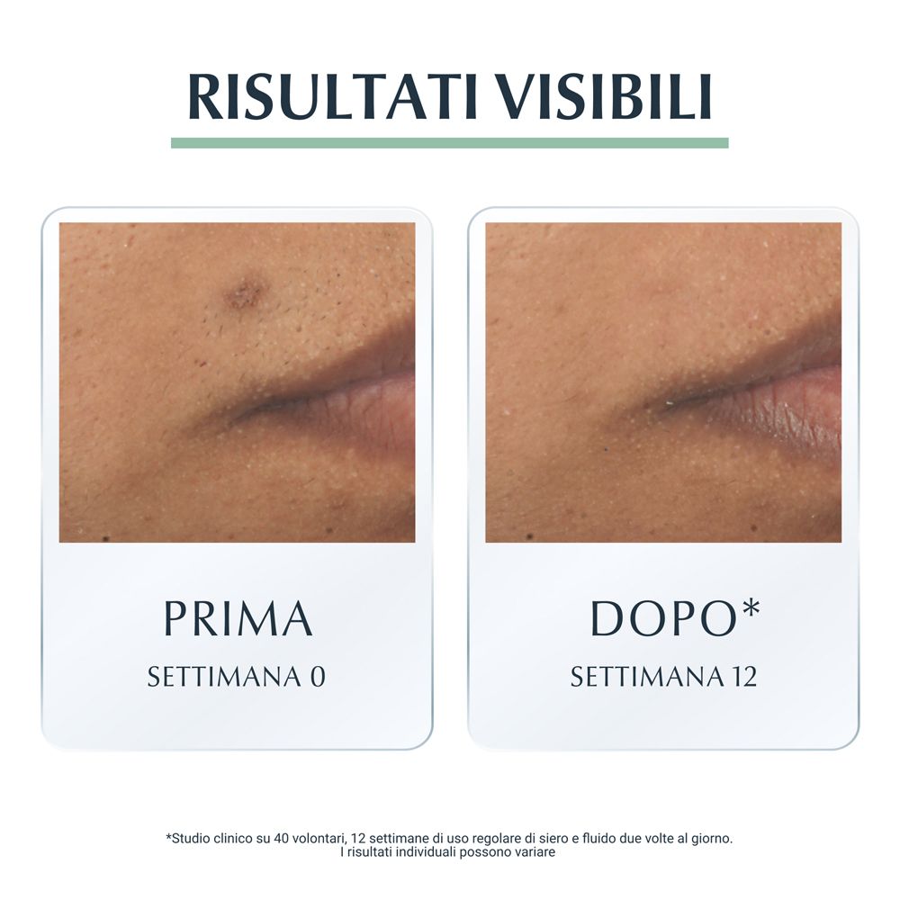 Confronto prima-dopo. Pelle con brufoli, poi pelle migliorata. Testo: Risultati visibili.