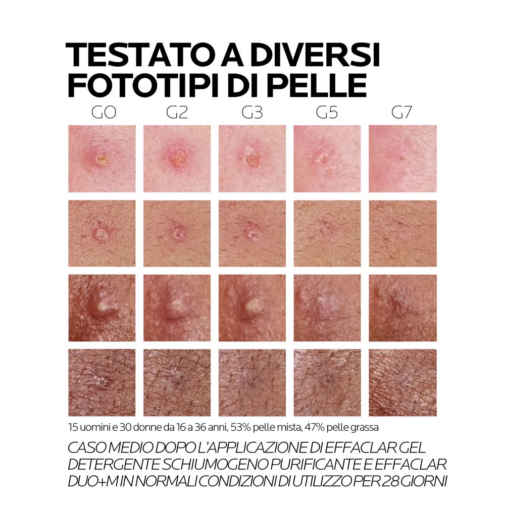 Test di Effaclar Gel Detergente Schiumogeno ed Effaclar Duo+M su diversi tipi di pelle. Foto della pelle.