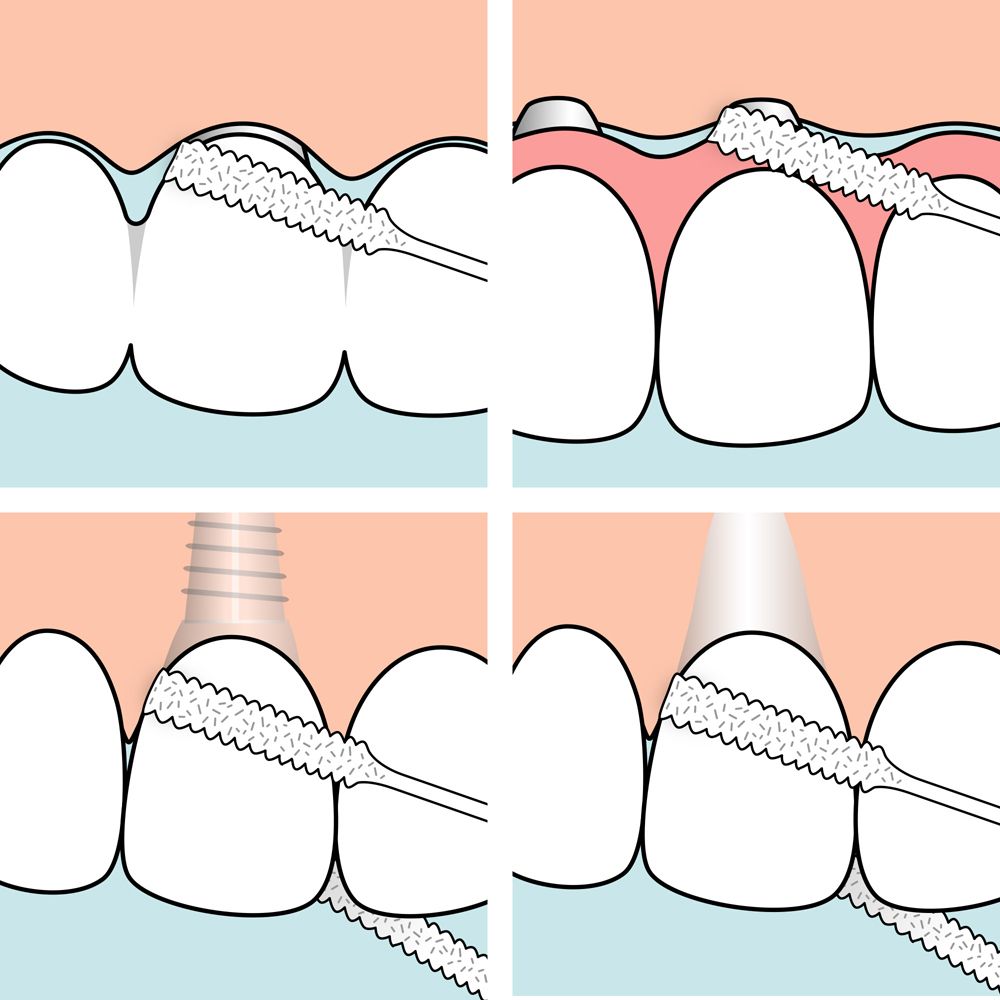 Illustrationen zur Reinigung von Zahnzwischenräumen, Zahnspangen und Implantaten.