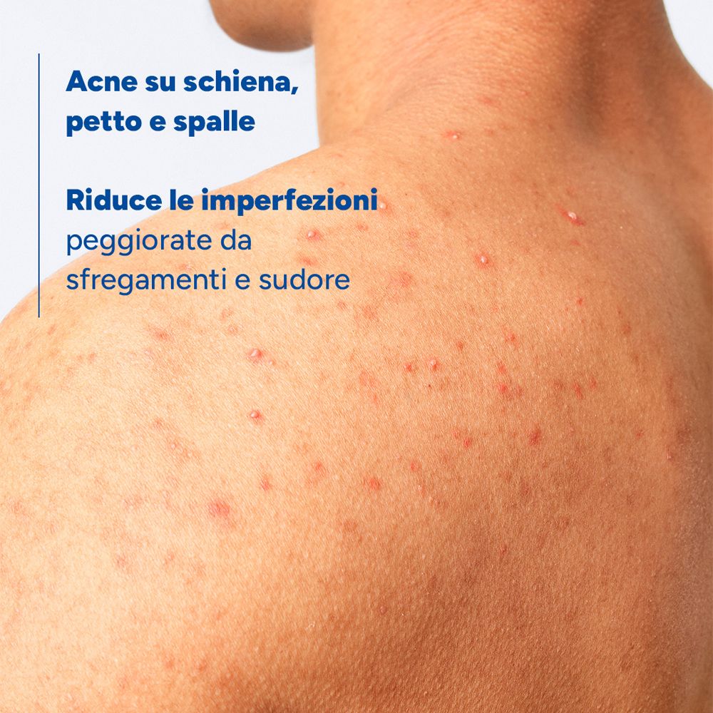 Schiena di un uomo con imperfezioni cutanee. Testo sull'acne di schiena, petto e spalle.