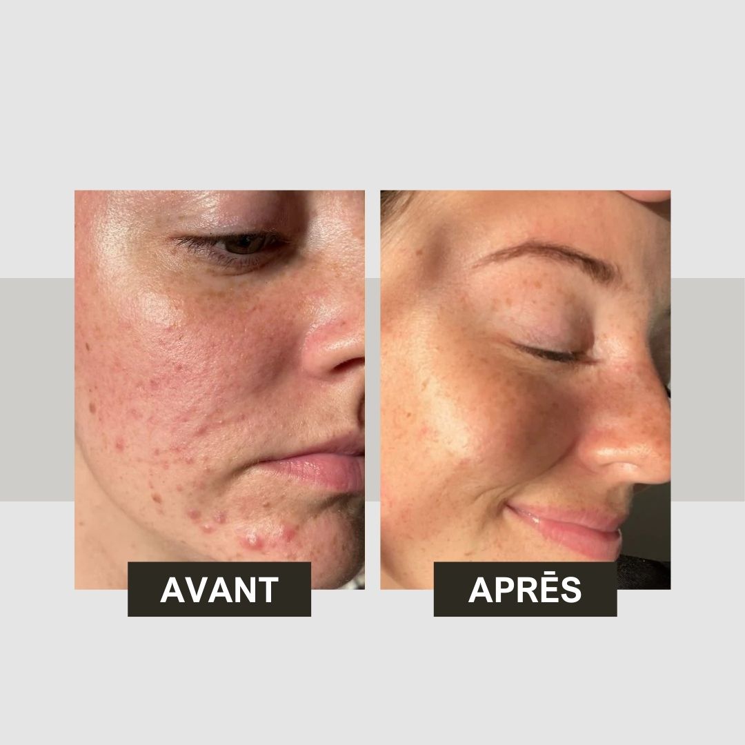 Comparaison avant-après de la peau. Gauche : peau avec imperfections. Droite : peau plus lisse. Texte : Avant, Après.