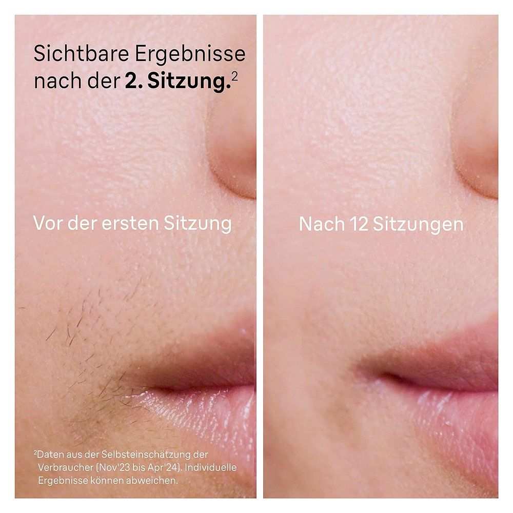 Vergleich von Haut vor und nach 12 IPL-Sitzungen, zeigt Haarreduktion.