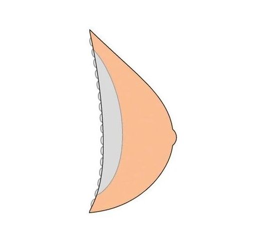 Seitenansicht einer Brustprothese. Hautfarben, mit einer Reihe von kleinen Noppen am Rand.