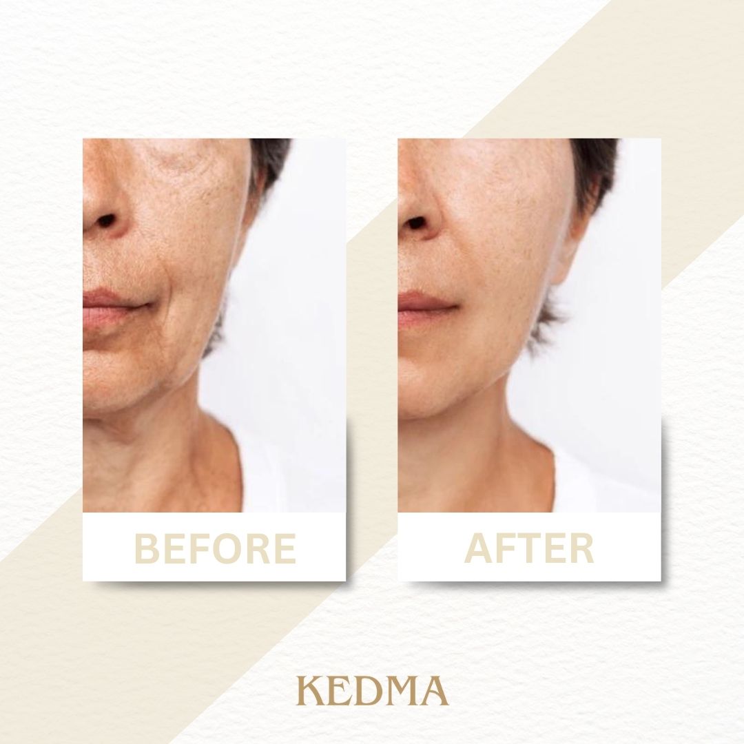 Image avant-après. Visage d'une femme. Logo Kedma.