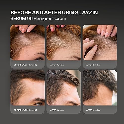 Voor- en na-afbeeldingen. Haar voor en na 9 en 12 weken. Tekst: BEFORE AND AFTER USING LAYZIN.