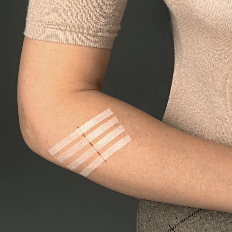 Arm mit Streifen. Auf der Haut sind vier weiße Streifen mit roten Markierungen angebracht.