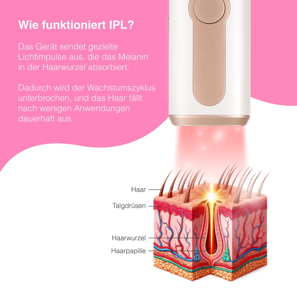 Diagramm zeigt IPL-Funktionsweise. Lichtimpulse, die Melanin absorbieren. Haarfollikel-Darstellung.