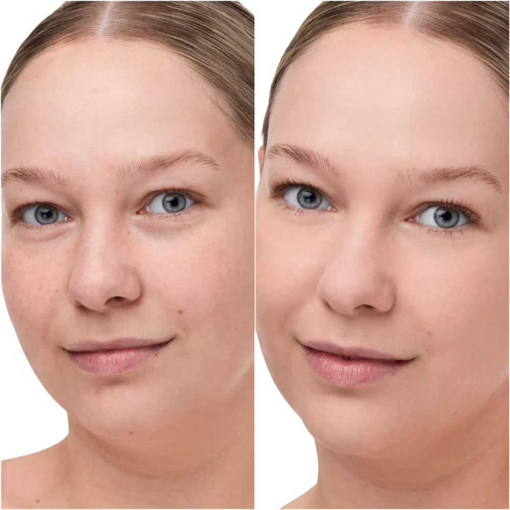 Gesicht einer Frau. Links: Haut mit Unreinheiten. Rechts: Haut mit ebenmäßigem Teint. Beide Gesichter zeigen blaue Augen und Lächeln.