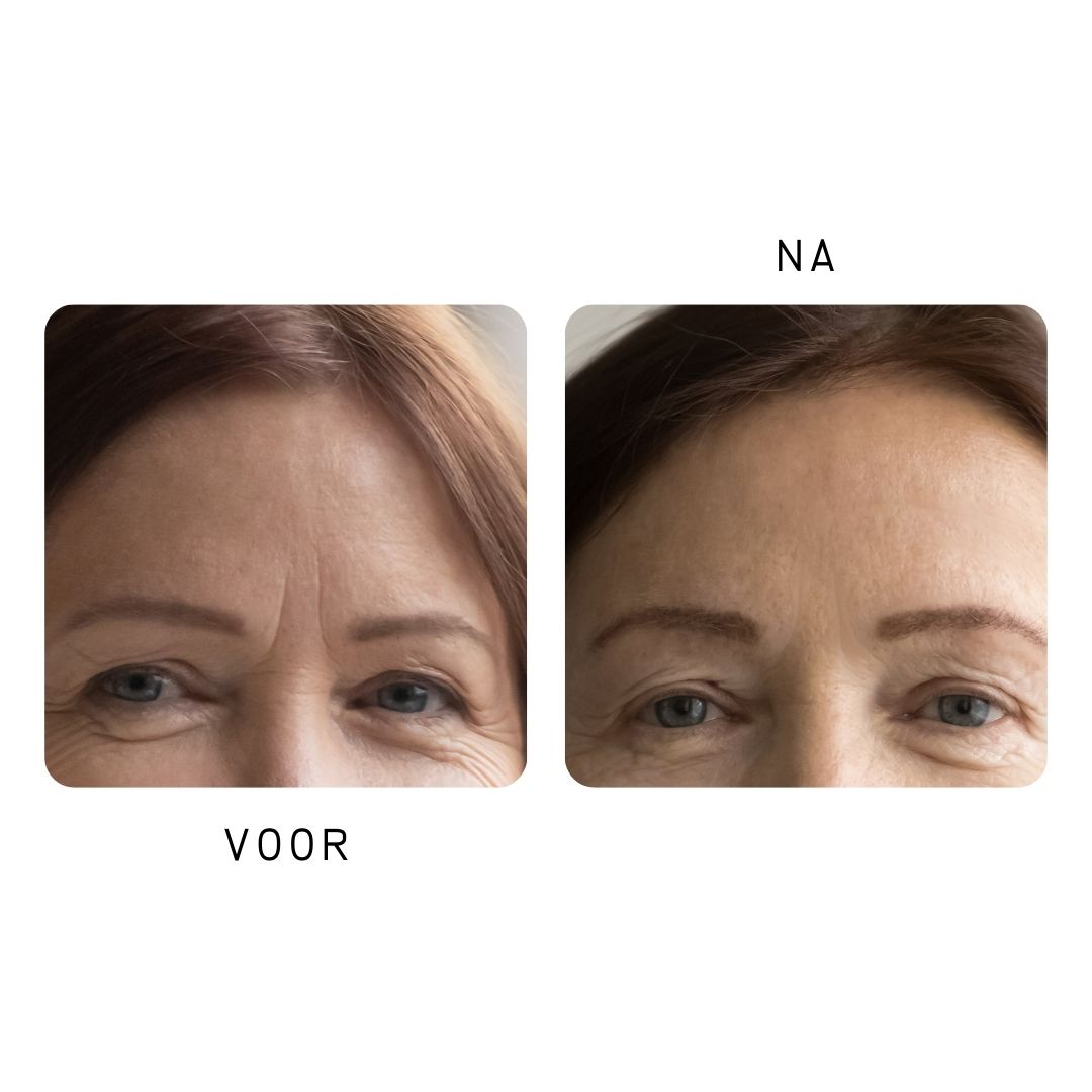 Voor- en navergelijking. Close-up van ogen en voorhoofd. Vermindering van rimpels.