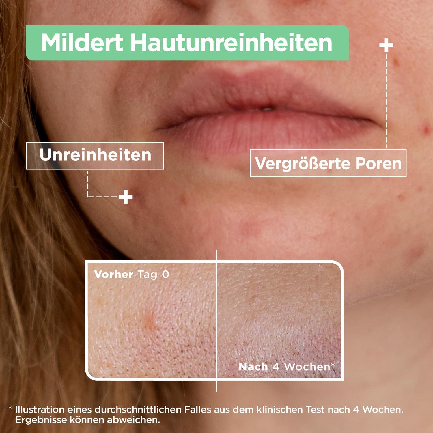 Mixa Anti-Unreinheiten Serum