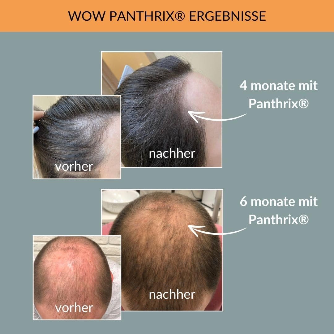 Images avant-après du cuir chevelu. Texte : 4 mois avec Panthrix, 6 mois avec Panthrix. Résultats.