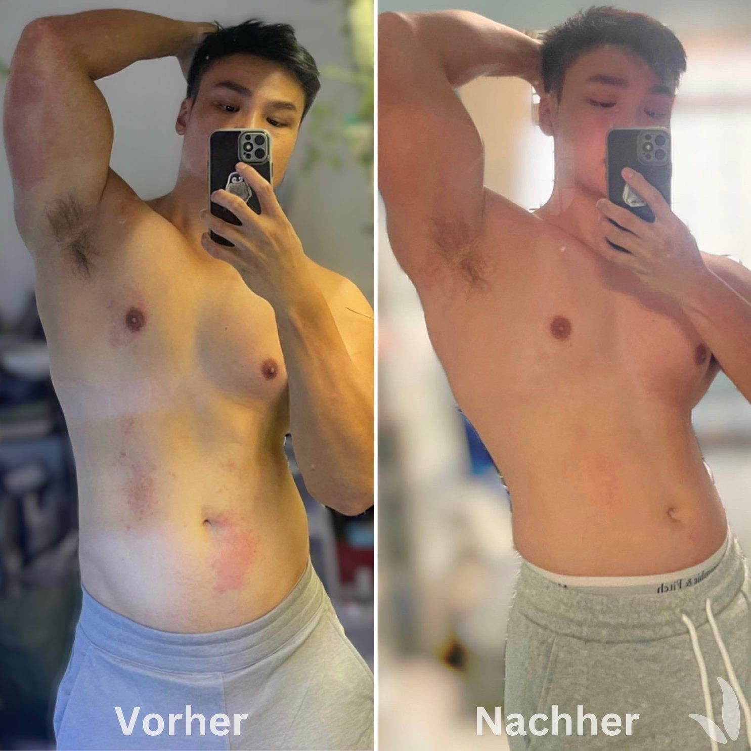 Zwei Fotos nebeneinander: Vorher und Nachher. Mann mit freiem Oberkörper, zeigt Hautveränderungen. Nachher: Haut verbessert.