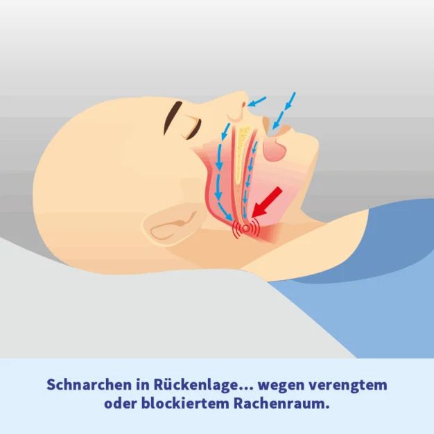Illustration: Mann im Schlaf mit verengtem Rachenraum. Pfeile und Text: Schnarchen in Rückenlage... wegen verengtem Rachenraum.