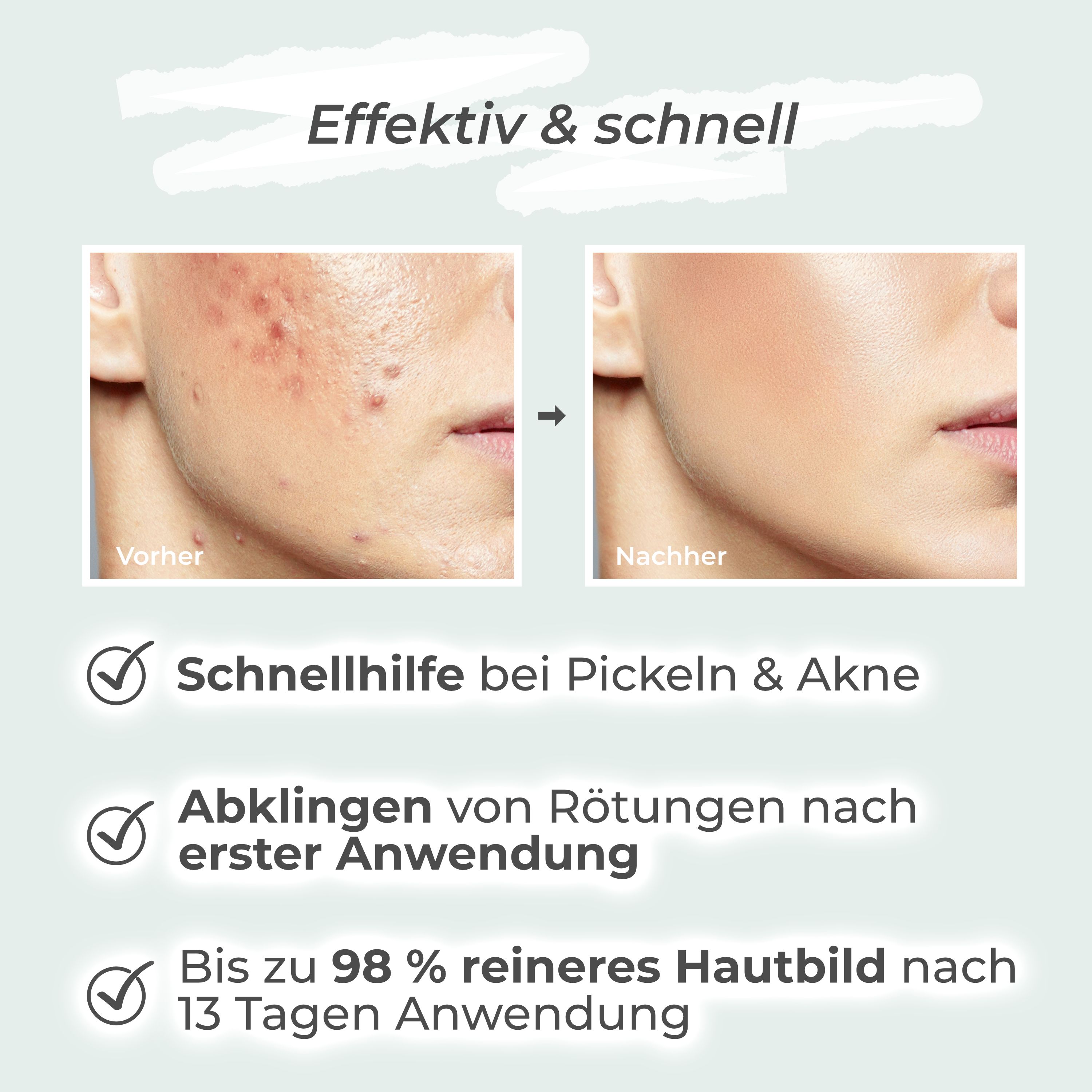 VIGOROUS® Zinkwasser & Zinksalbe gegen Pickel und unreine Haut